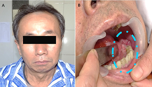 Preoperative photograph. A:On inspection left mandible is slightly protruded. B:Gingival lesion (blue dashed line).